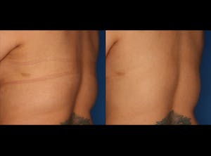 Before and After of CoolSculpting in San Diego