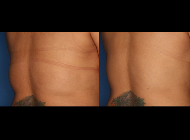 CoolSculpting Before & After Gallery - Patient 24560505 - Image 2