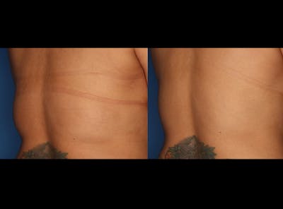 CoolSculpting Gallery Before & After Gallery - Patient 24560505 - Image 2