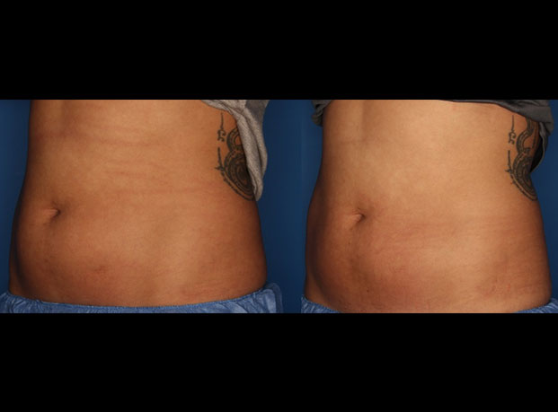 CoolSculpting Before & After Gallery - Patient 24560515 - Image 2