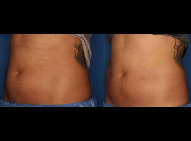 CoolSculpting Gallery Before & After Gallery - Patient 24560515 - Image 2