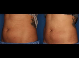 Before and After of CoolSculpting in La Jolla