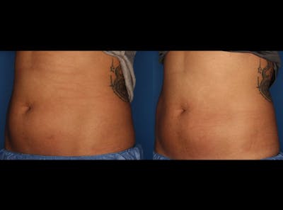 CoolSculpting Gallery Before & After Gallery - Patient 24560515 - Image 2
