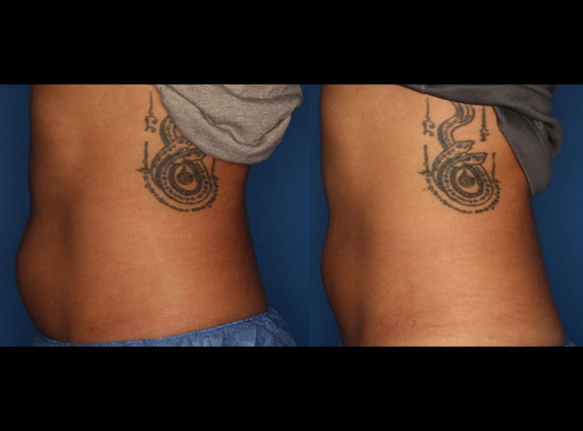 CoolSculpting Gallery Before & After Gallery - Patient 24560515 - Image 1