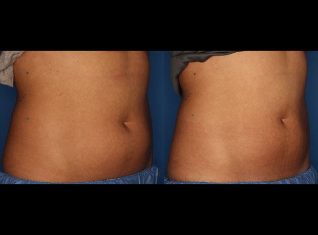 CoolSculpting Gallery Before & After Gallery - Patient 24560515 - Image 3