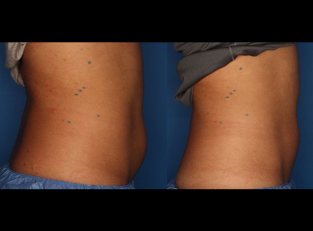 CoolSculpting Before & After Gallery - Patient 24560515 - Image 4