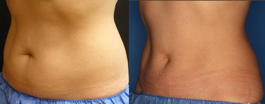 CoolSculpting Before & After Gallery - Patient 24560528 - Image 1