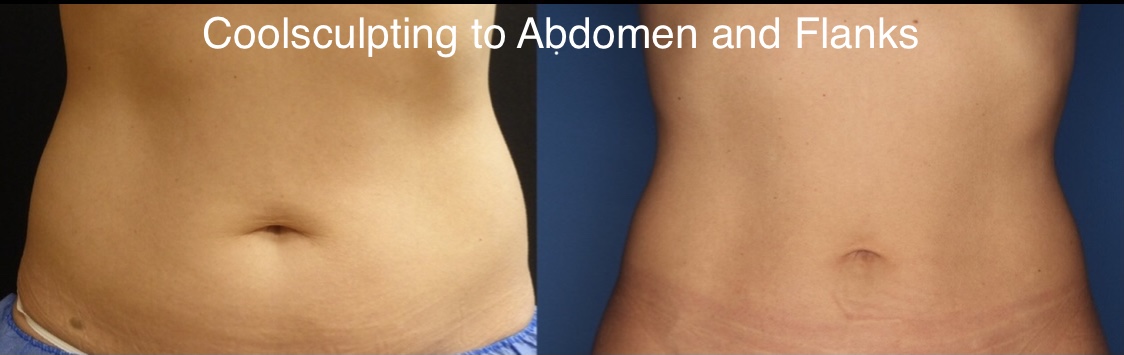 CoolSculpting Gallery Before & After Gallery - Patient 24560528 - Image 2
