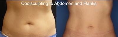 CoolSculpting Gallery Before & After Gallery - Patient 24560528 - Image 2