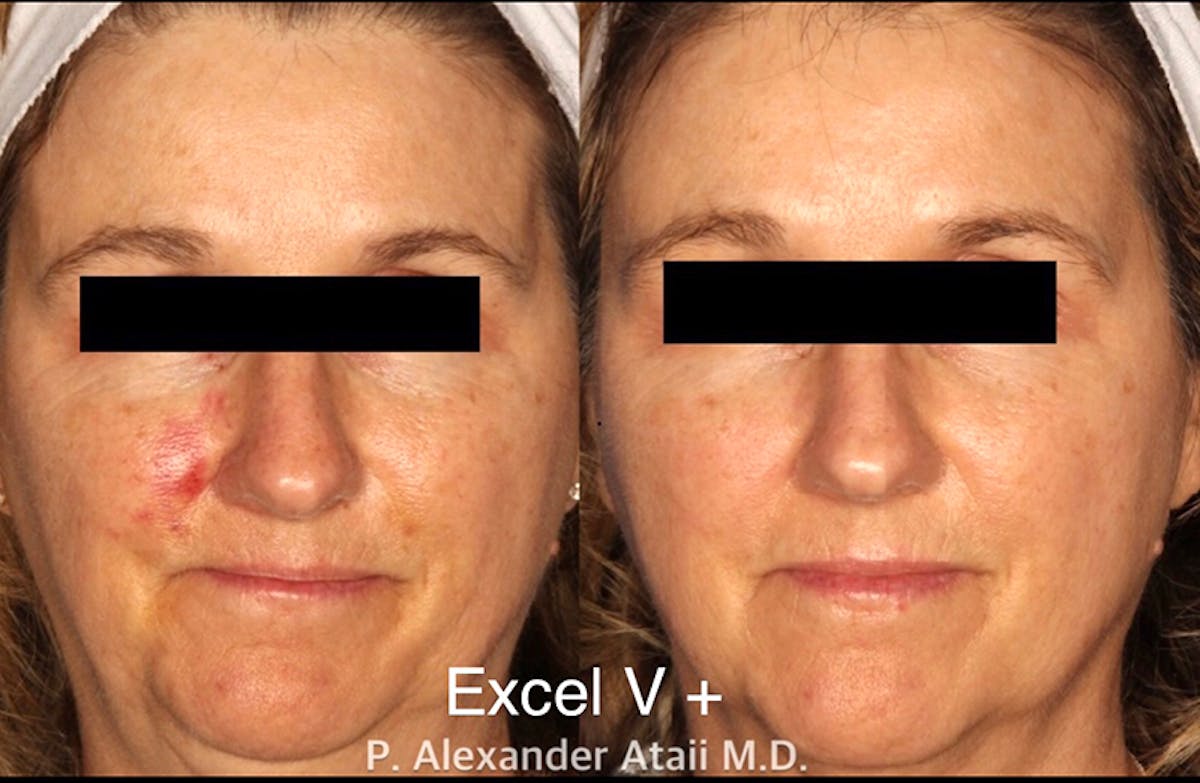Excel V. Before & After Gallery - Patient 24560523 - Image 1
