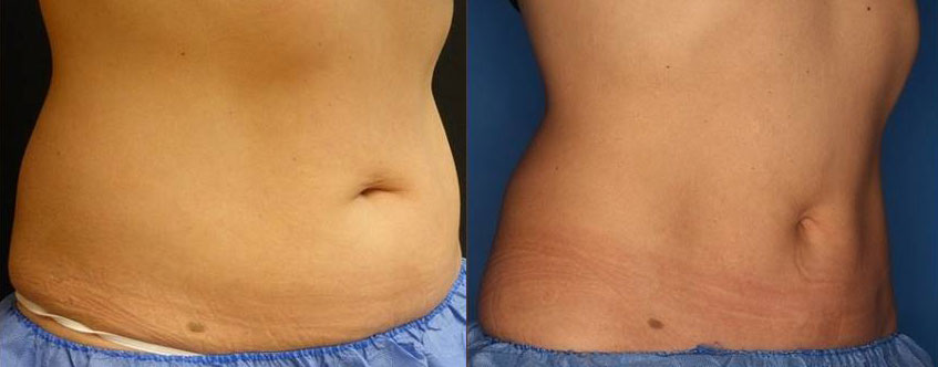 CoolSculpting Before & After Gallery - Patient 24560528 - Image 3