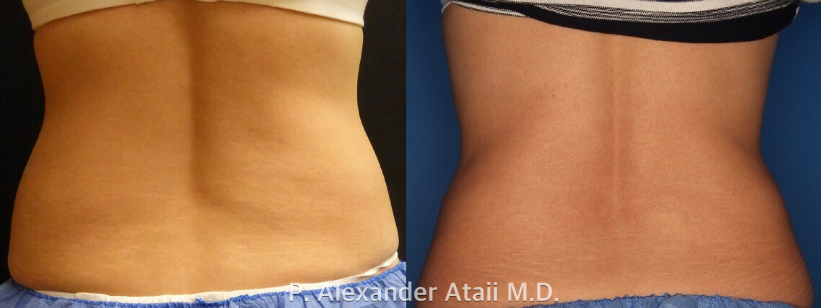 CoolSculpting Before & After Gallery - Patient 24560528 - Image 4
