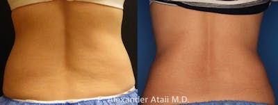 CoolSculpting Before & After Gallery - Patient 24560528 - Image 4
