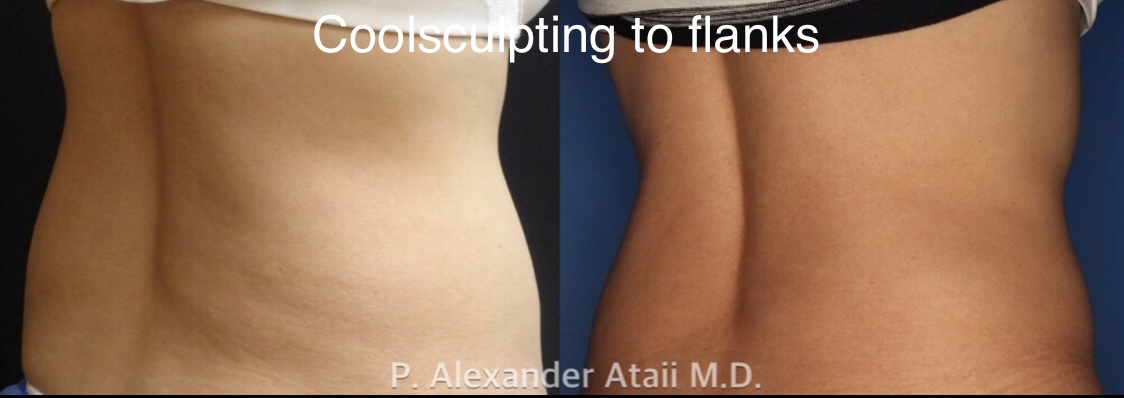 CoolSculpting Before & After Gallery - Patient 24560528 - Image 5
