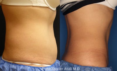CoolSculpting Before & After Gallery - Patient 24560528 - Image 6