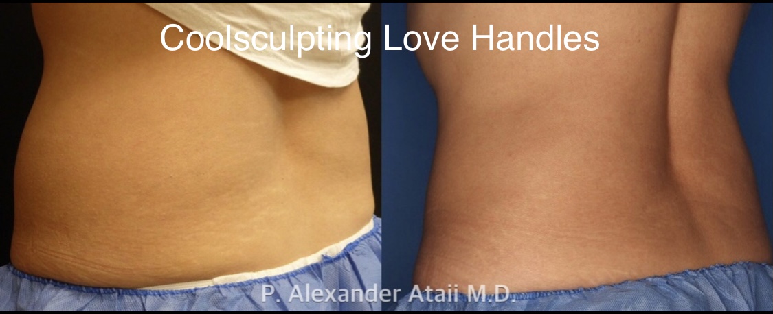 CoolSculpting Before & After Gallery - Patient 24560528 - Image 7