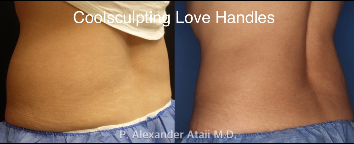 CoolSculpting Gallery Before & After Gallery - Patient 24560528 - Image 7