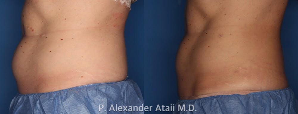 CoolSculpting Gallery - Patient 24560539 - Image 1