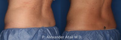 CoolSculpting Before & After Gallery - Patient 24560539 - Image 2