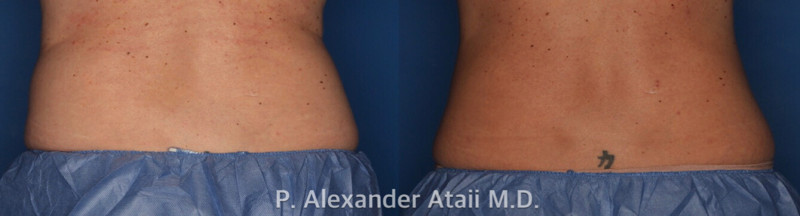 CoolSculpting Before & After Gallery - Patient 24560539 - Image 3