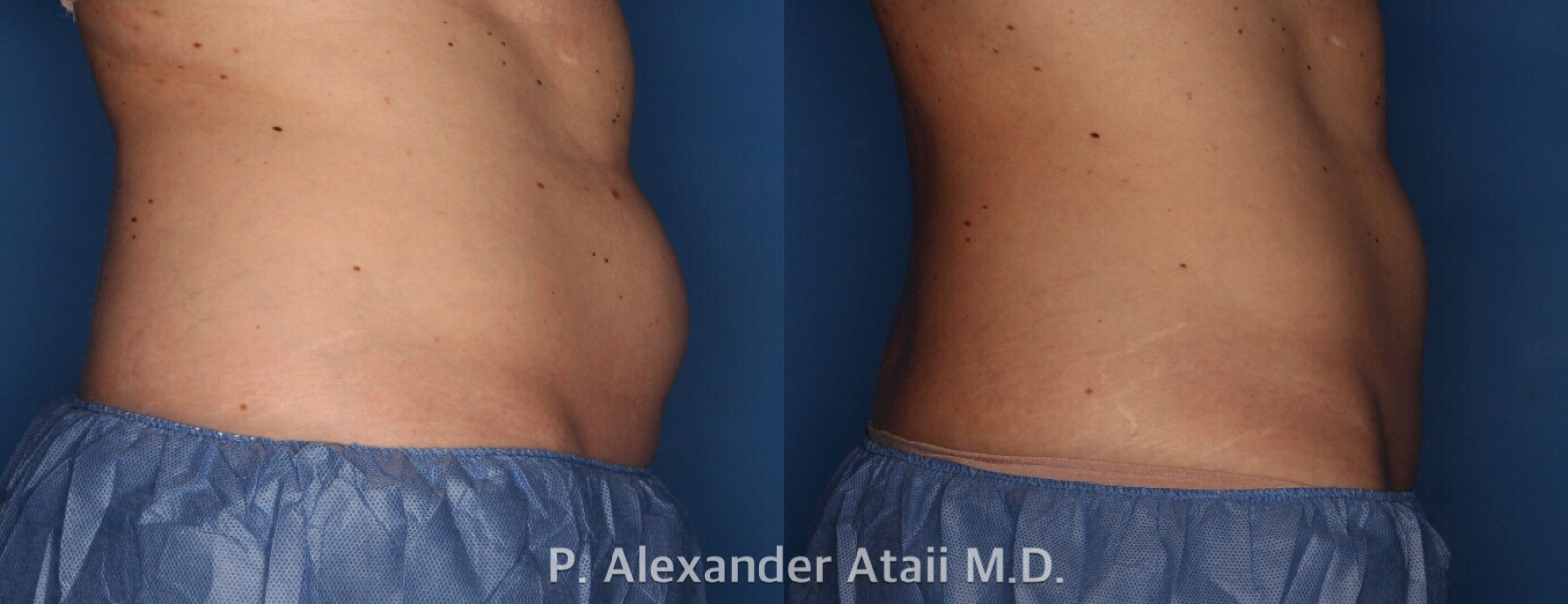 CoolSculpting Before & After Gallery - Patient 24560539 - Image 4
