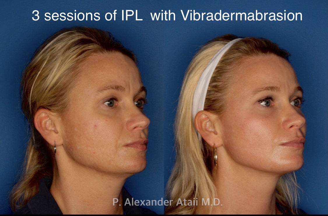IPL Photorejuvenation Before & After Gallery - Patient 24560548 - Image 2
