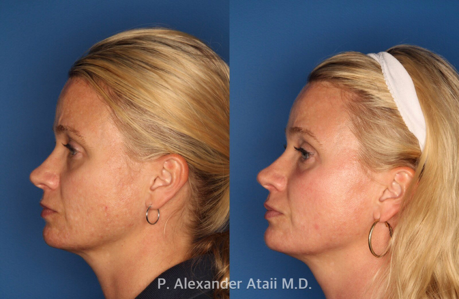 IPL Photorejuvenation Gallery Before & After Gallery - Patient 24560548 - Image 3