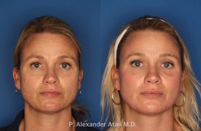 IPL Photorejuvenation Gallery Before & After Gallery - Patient 24560548 - Image 4