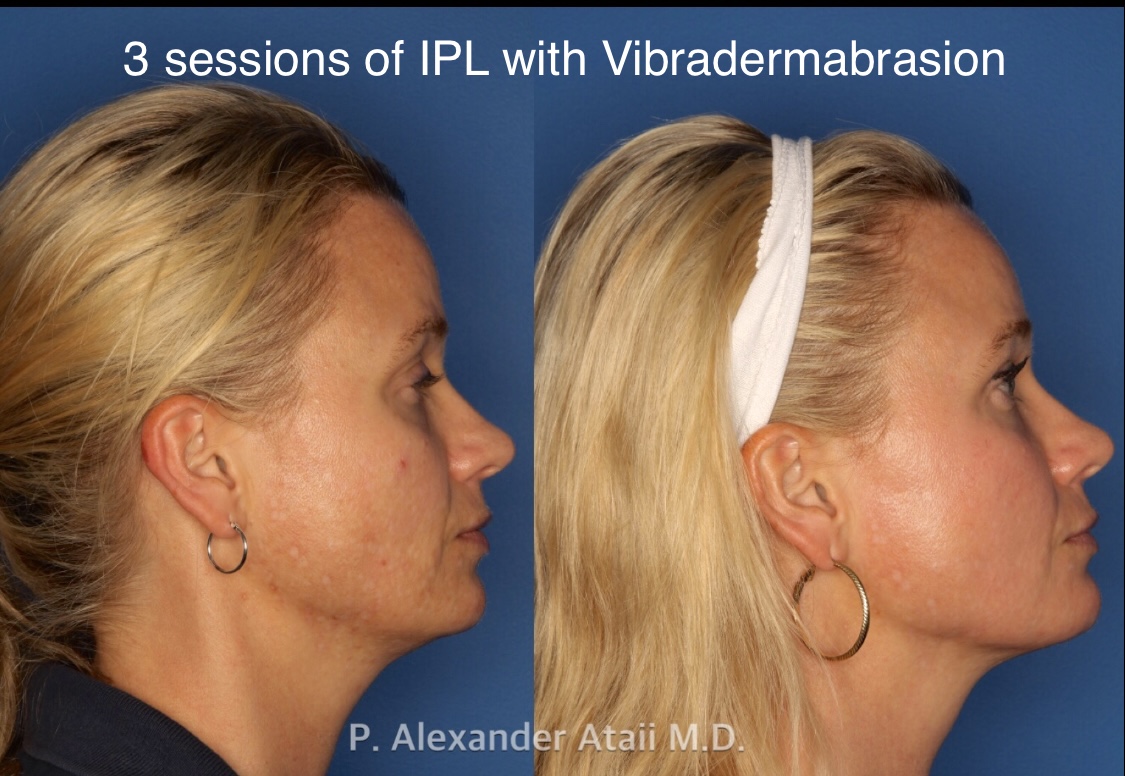 IPL Photorejuvenation Gallery Before & After Gallery - Patient 24560548 - Image 5