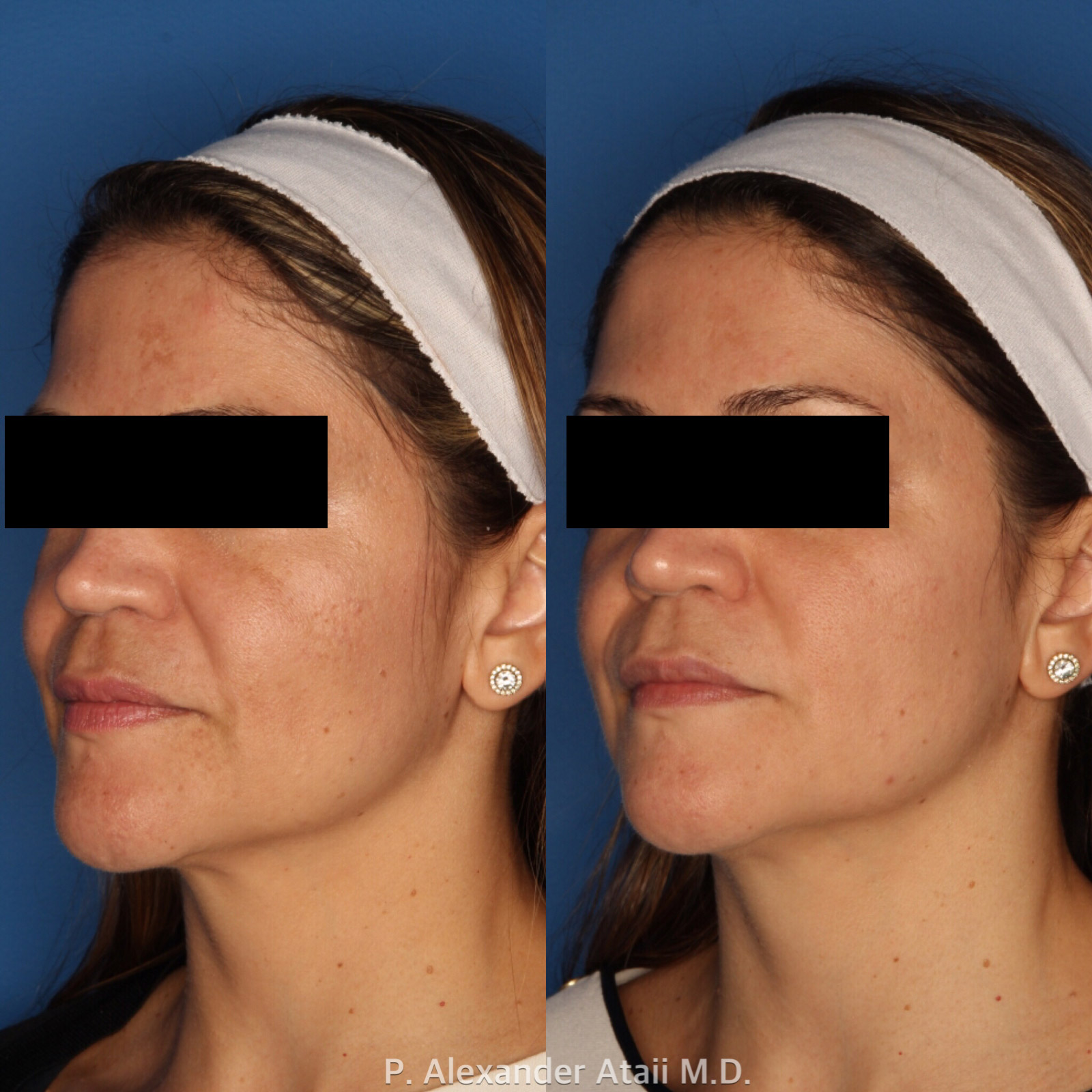LaserFirm Before & After Gallery - Patient 24560561 - Image 1