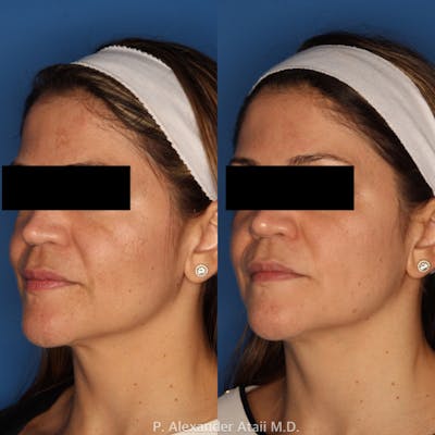 LaserFirm Gallery Before & After Gallery - Patient 24560561 - Image 1