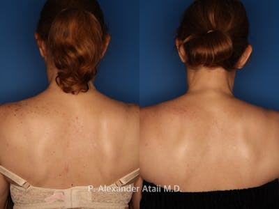 IPL Photorejuvenation Gallery Before & After Gallery - Patient 24560557 - Image 2