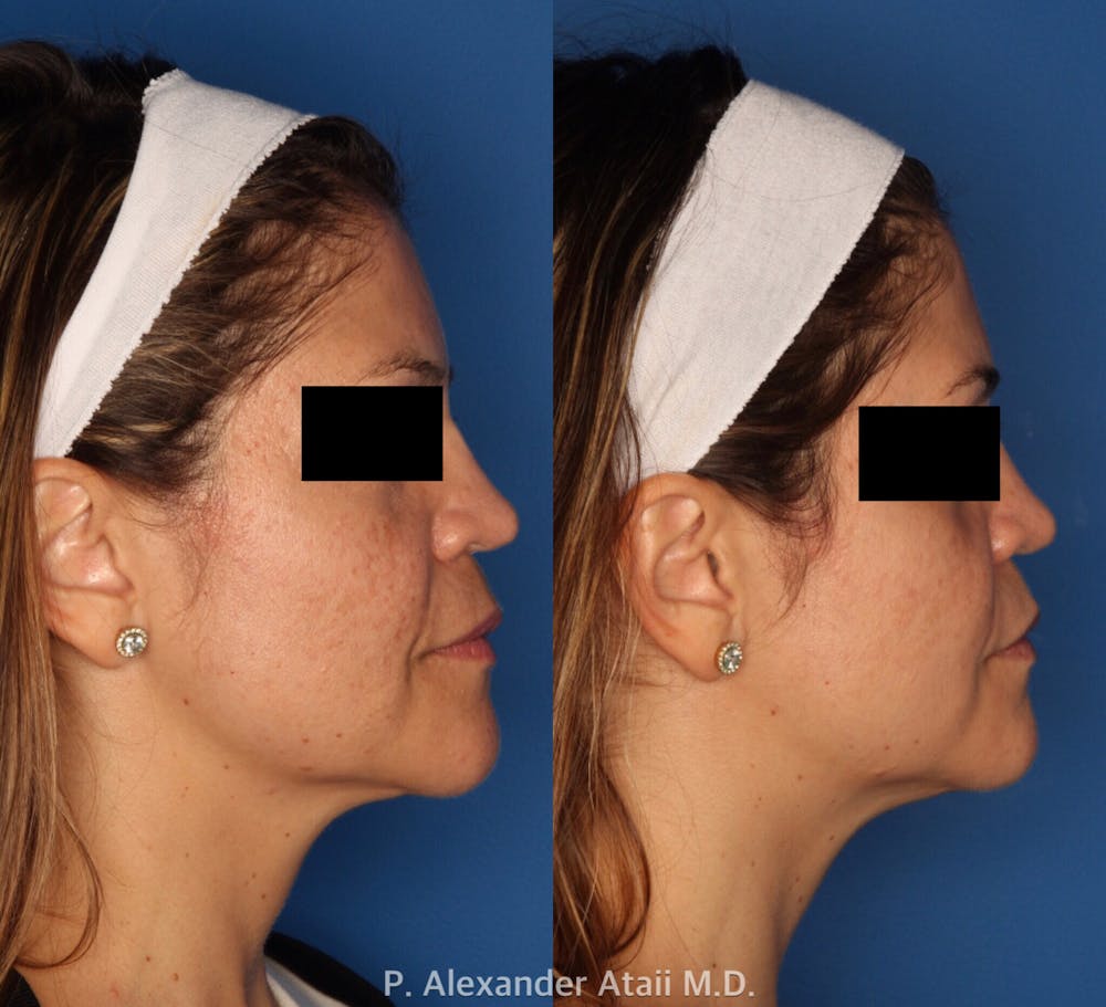 LaserFirm Before & After Gallery - Patient 24560561 - Image 2
