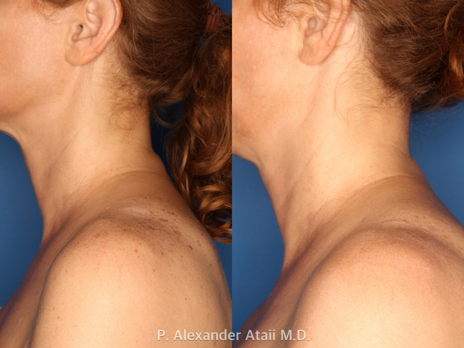 IPL Photorejuvenation Gallery Before & After Gallery - Patient 24560557 - Image 3