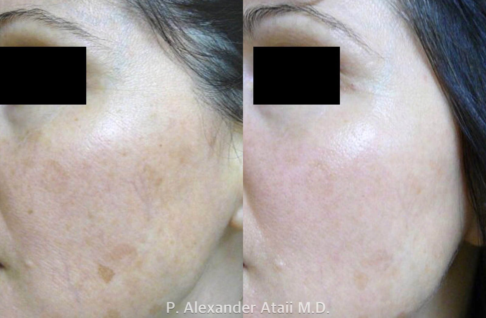 LaserFirm Before & After Gallery - Patient 24560571 - Image 1