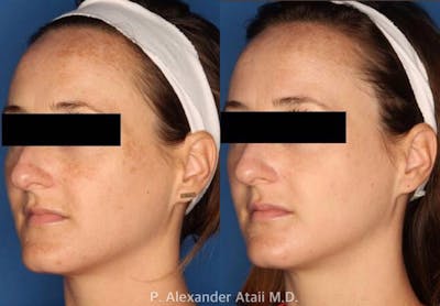IPL Photorejuvenation Gallery Before & After Gallery - Patient 24560572 - Image 2
