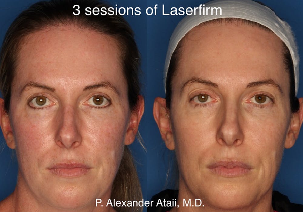 LaserFirm