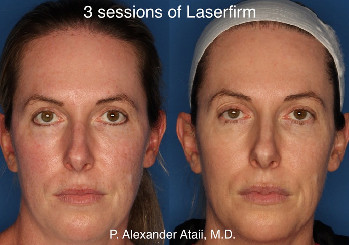 LaserFirm Gallery Before & After Gallery - Patient 24560576 - Image 1