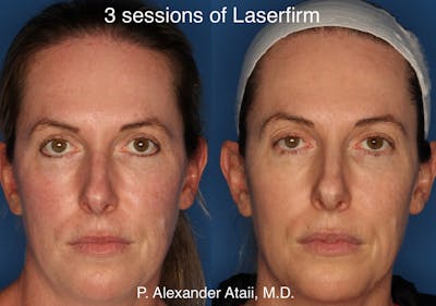 LaserFirm Gallery Before & After Gallery - Patient 24560576 - Image 1