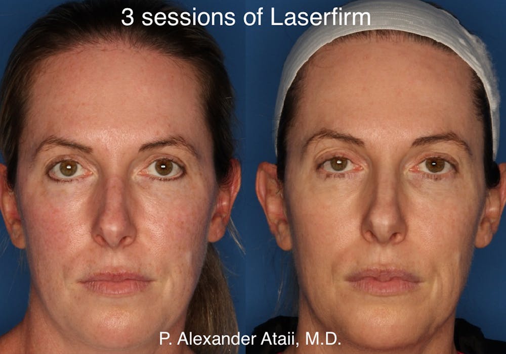 LaserFirm Before & After Gallery - Patient 24560576 - Image 1