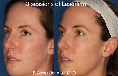 LaserFirm Gallery Before & After Gallery - Patient 24560576 - Image 2