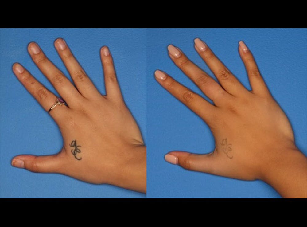 Laser Tattoo Removal