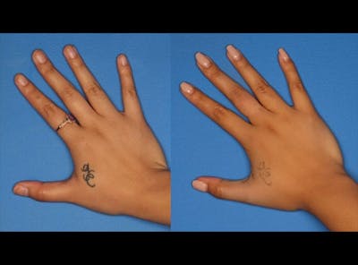 Laser Tattoo Removal Before & After Gallery - Patient 24560575 - Image 1