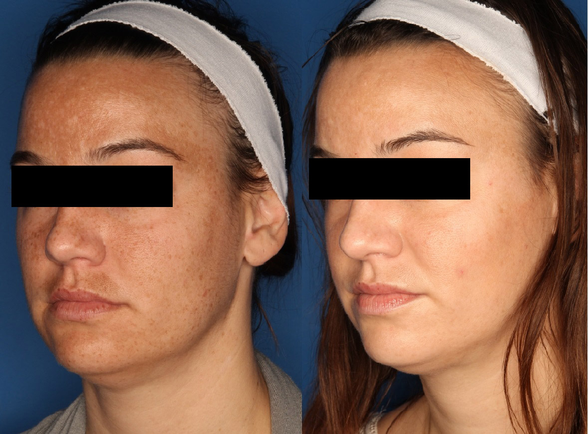 IPL Photorejuvenation Gallery Before & After Gallery - Patient 24560577 - Image 2