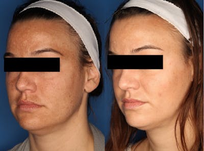 IPL Photorejuvenation Gallery Before & After Gallery - Patient 24560577 - Image 2