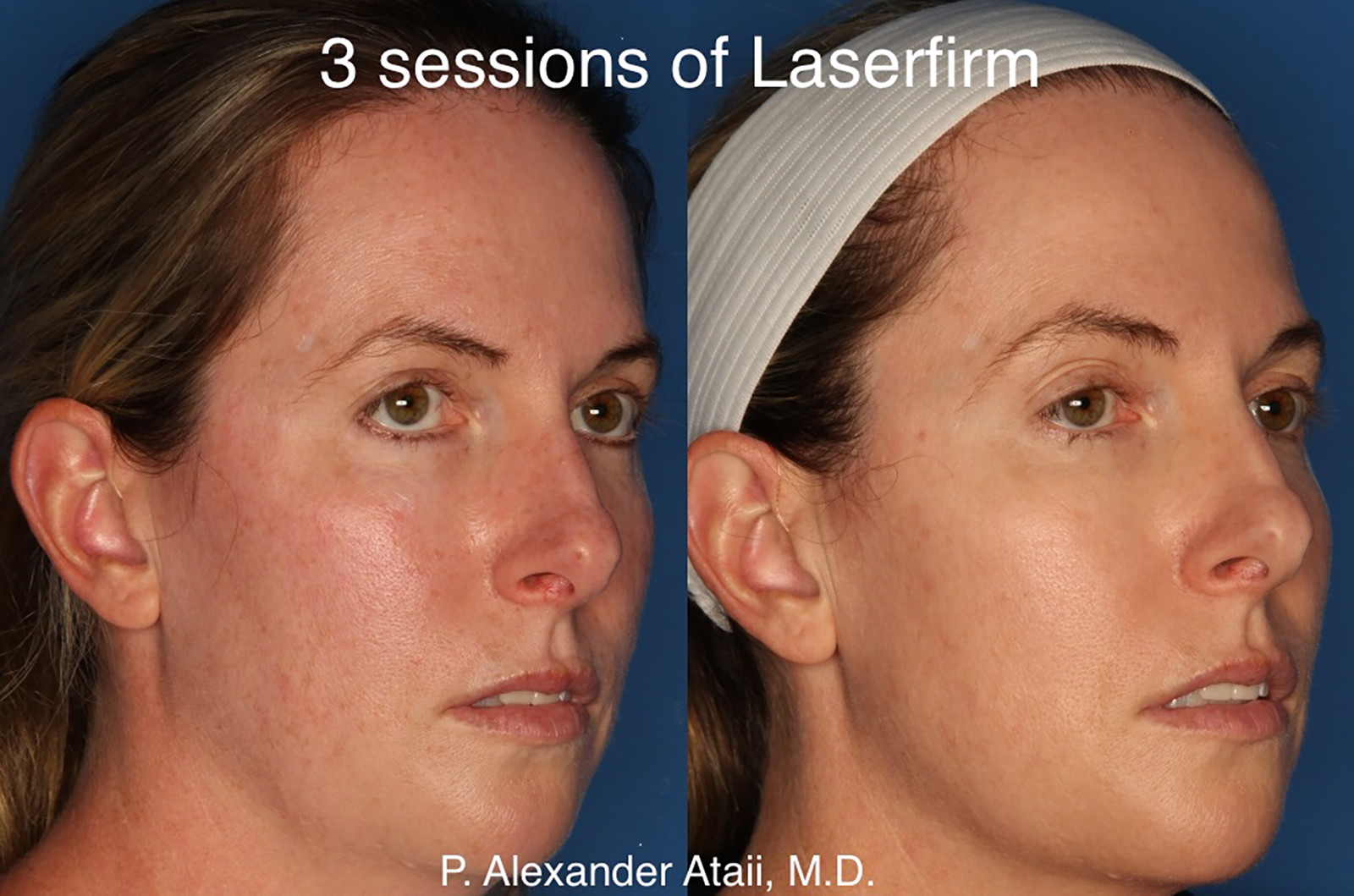 LaserFirm Before & After Gallery - Patient 24560576 - Image 3