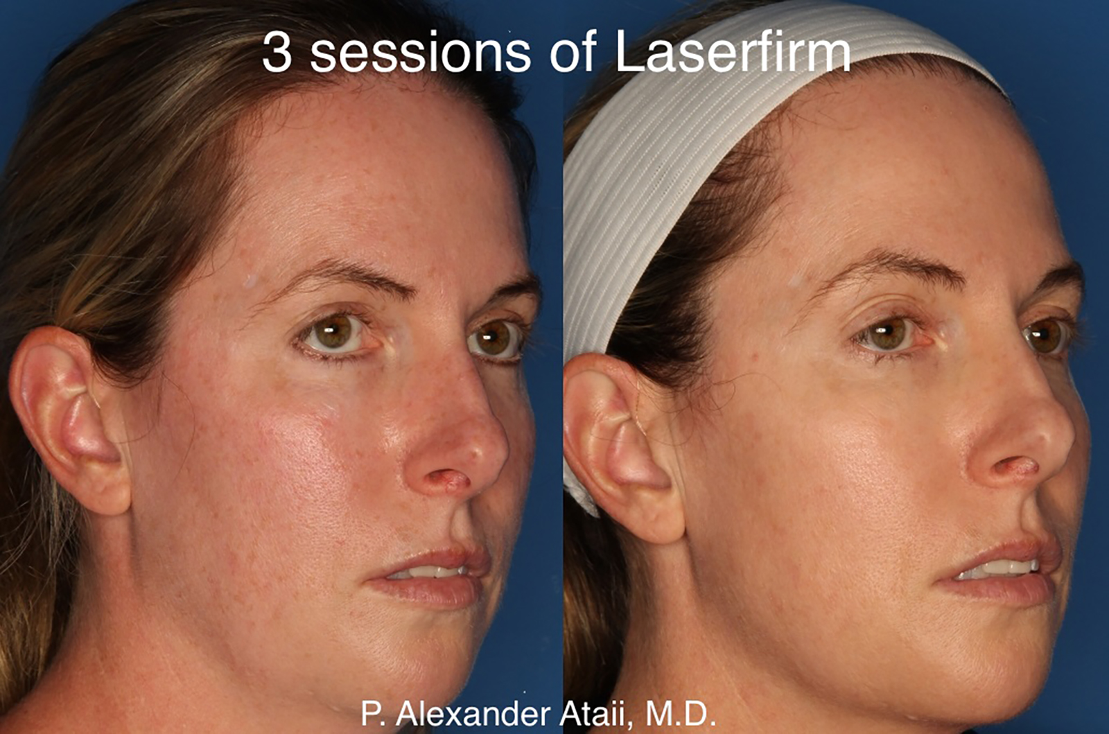 LaserFirm Gallery Before & After Gallery - Patient 24560576 - Image 3