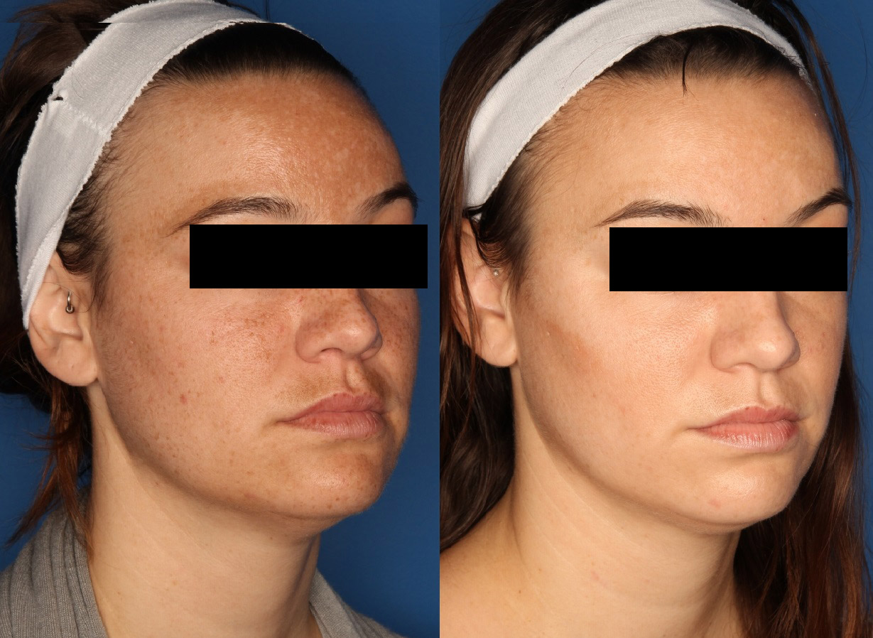 IPL Photorejuvenation Gallery Before & After Gallery - Patient 24560577 - Image 3