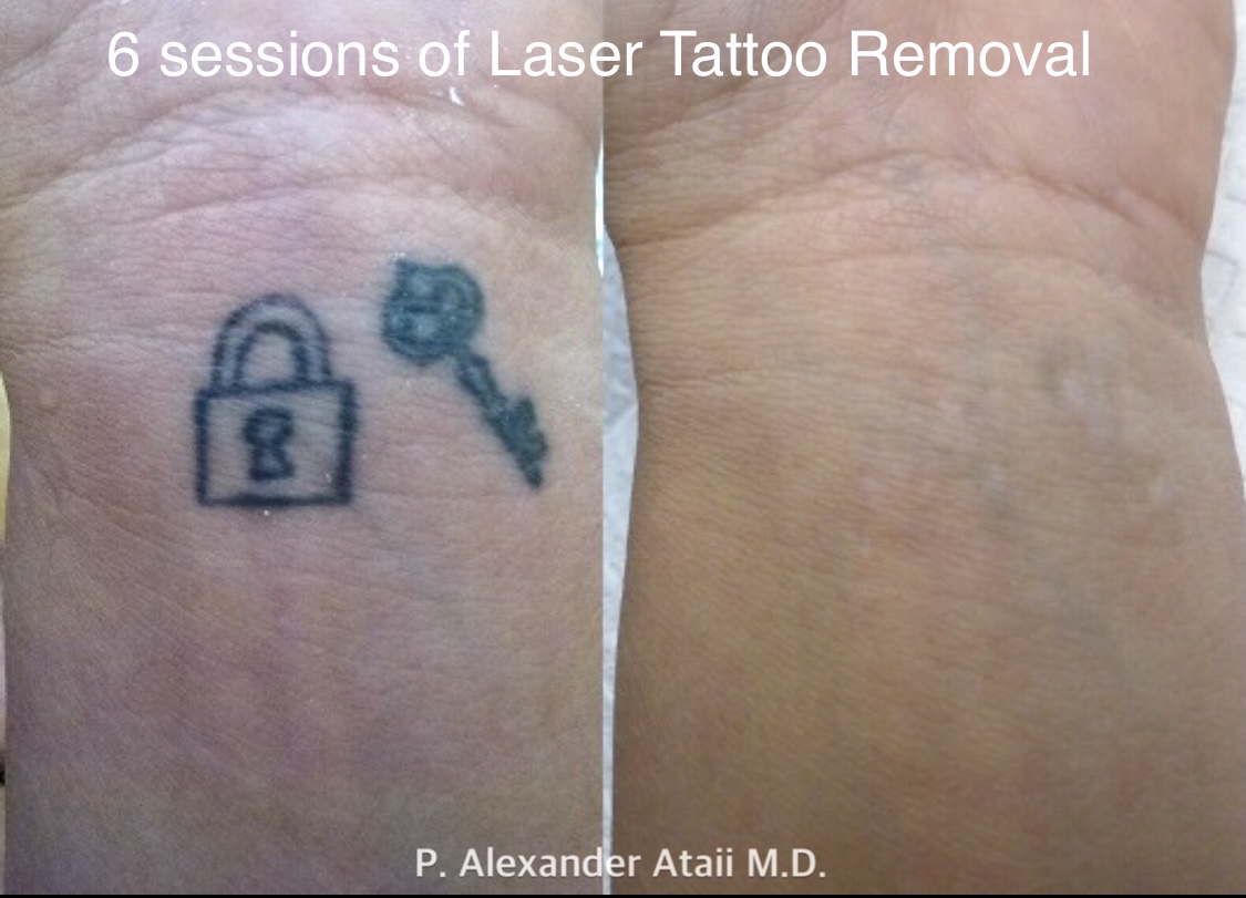 Laser Tattoo Removal Before & After Gallery - Patient 24560578 - Image 1