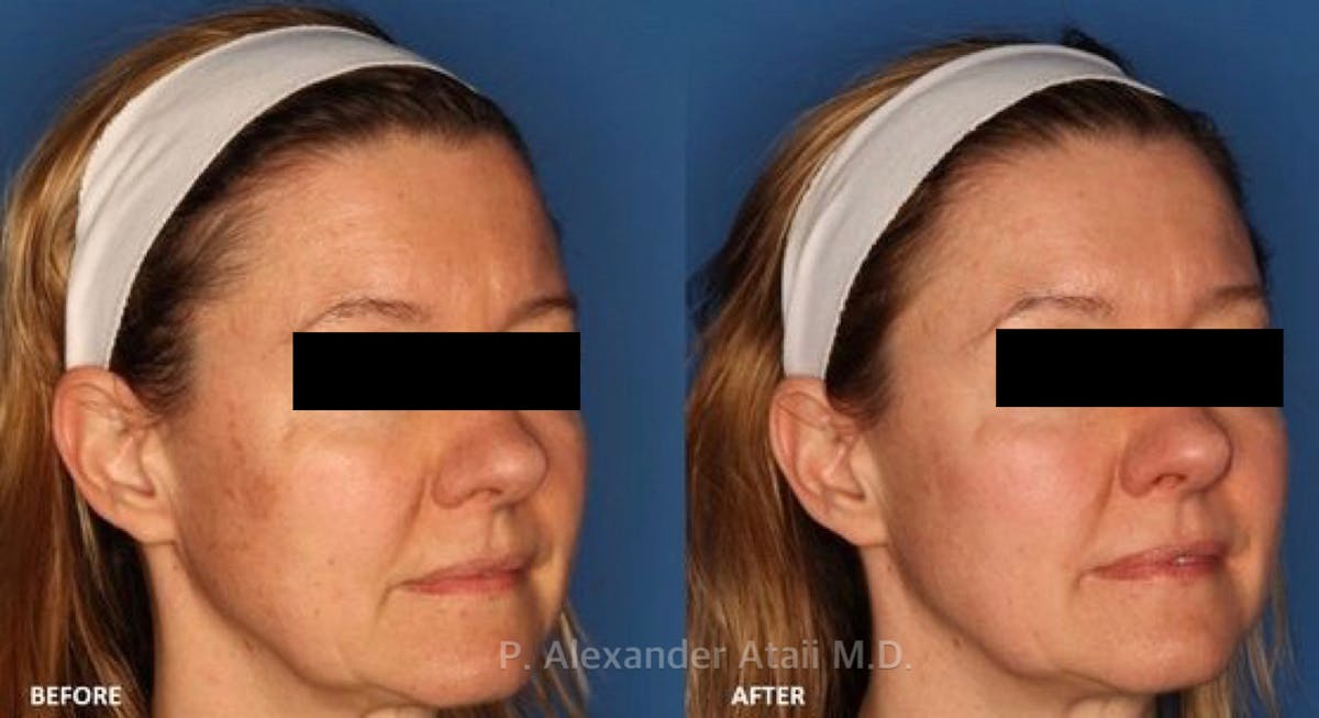 IPL Photorejuvenation Gallery Before & After Gallery - Patient 24560580 - Image 1